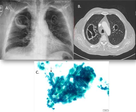 Cavitary lung lesions in an immunosuppressed patient - International ...