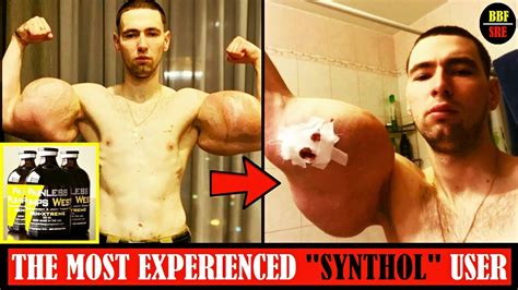 💉The Synthol Kid & His Synthol Oil Abuse ⏯ Site Injection Theory Gone ...