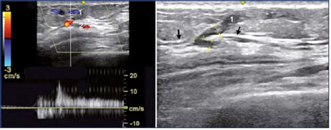 The transosseous perforator veins of the knee - Servier ...