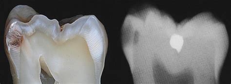 Dental Caries Radiograph