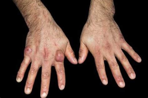 Rheumatoid Nodules Wrist