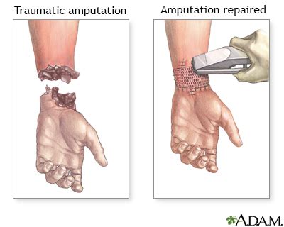 Amputation - traumatic Information | Mount Sinai - New York