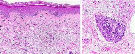 Biopsy demonstrates burned out lichenoid interface dermatitis with ...