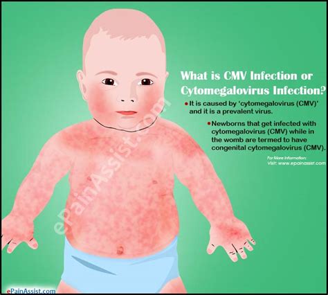 What is a CMV Infection?