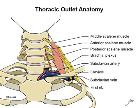 Thoracic Outlet Syndrome (TOS) - MSK - Medbullets Step 1