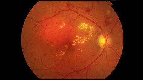 AMD and Retinal Disease | Medscape