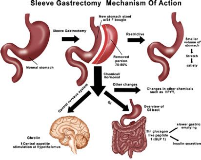 Laparoscopic Vertical Sleeve Gastrectomy - Surgical Clinics