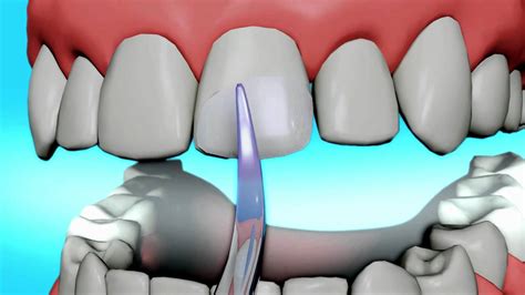 What is the procedure of teeth bonding before and after?