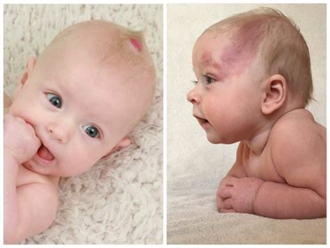 Beautiful birthmarks! | BabyCenter