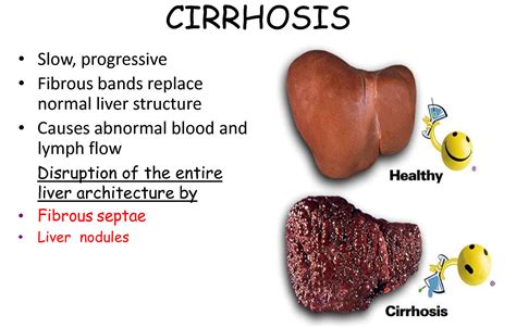 What You Need to Know About Cirrhosis – Protecting and Treatment ...