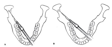 Modified Extra-oral Landmarks for the Gow-Gates Mandibular Division ...