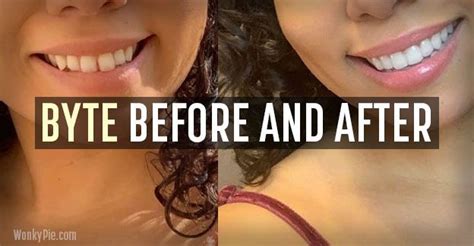 Byte Aligners: 21 Before & After Photos (Pics of Real Results ...