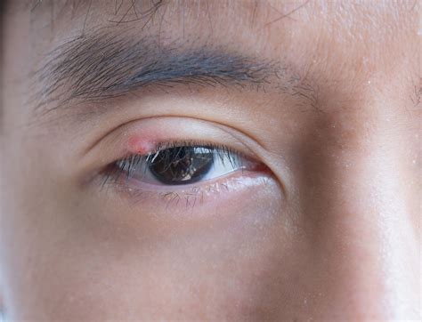 Chalazion vs. Stye: Symptoms, Causes, and Treatment