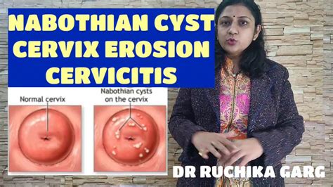 Nabothian Cyst Cervix क्या हैं हिंदी Chronic Cervicitis Treatmnt Can ...