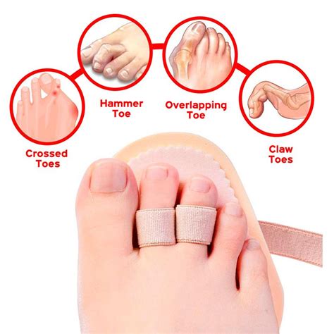 Wilsons Triple Toe Straightener, Toe Splint The #1 Option For Hammer ...