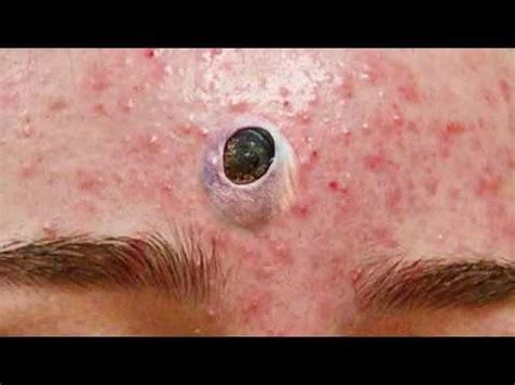 Big Blackheads, Cyst and Forehead Pimples - YouTube