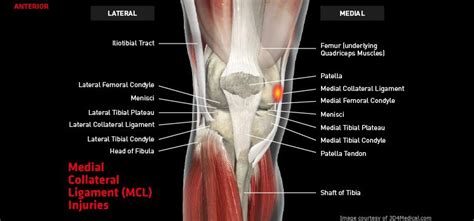 medial collateral ligament injury - Carolyn Tucker