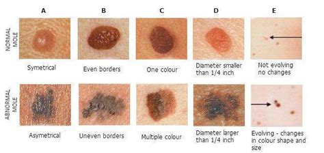 What is the ABCDE Rule of Skin Cancer: Outer Banks Dermatology: Board ...