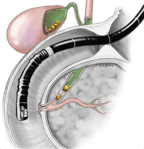 Figure 031_0351. Endoscopic retrograde cholangiopancreatography (ERCP ...