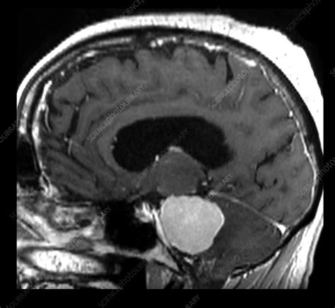 MRI Large Acoustic Schwannoma (Vestibular Schwannoma) - Stock Image ...