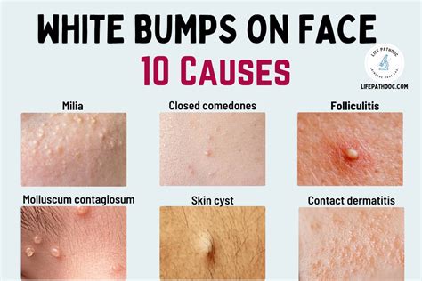 White Bumps on Face: Milia and 9 Other Causes