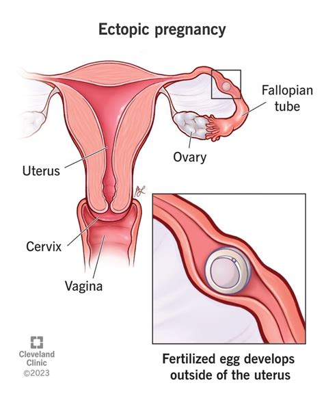 Understanding Ectopic Pregnancy: Causes, Symptoms, and Treatment - Ask ...