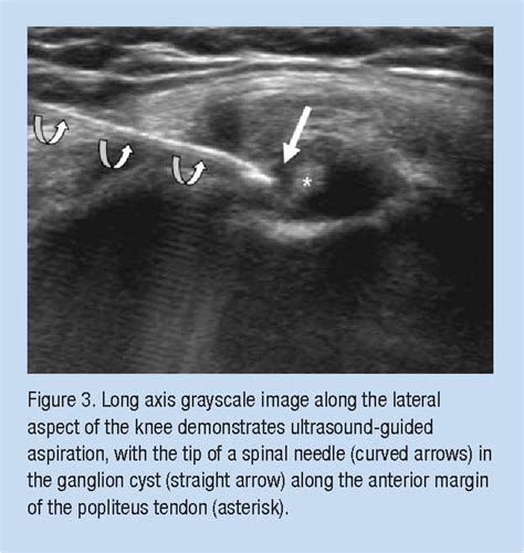 Symptomatic Ganglion Cyst of the Popliteus Tendon Treated With ...