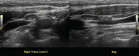 Normal Cervical Lymph Node Appearance and Anatomic Landmarks in Neck ...