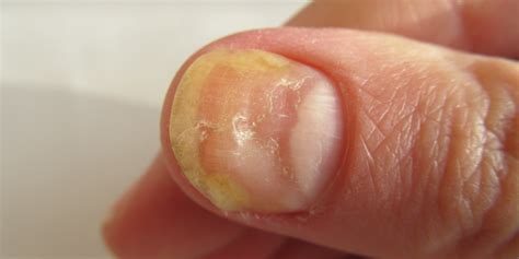 Nail Disorders - San Luis Obispo, CA | Coastal Dermatology + Aesthetics