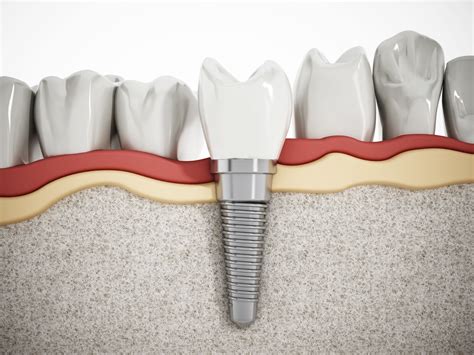 Dental Implants 101: What Is a Dental Abutment? – Miosuperhealth