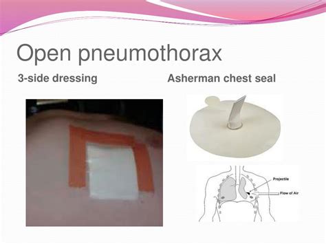 PPT - CARE OF PATIENT WITH CHEST INJURIES PowerPoint Presentation, free ...