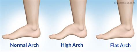 Flat feet vs High foot arch - Mandurah Physiotherapy