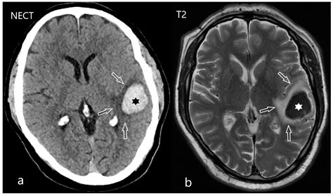 Intracerebral Hemorrhage Mri