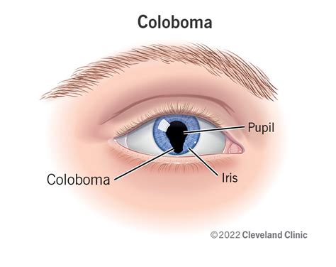 Coloboma: Types, Causes & Associated Conditions