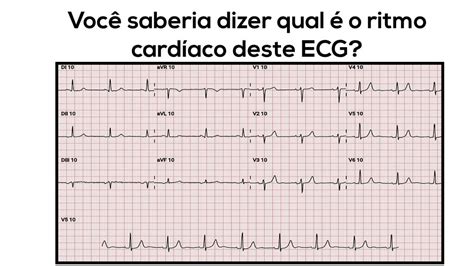 Você saberia dizer qual ritmo cardíaco deste ECG? – CardioSite