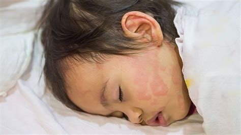 What Are Hives? Symptoms, Causes, Diagnosis, Treatment, and Prevention ...