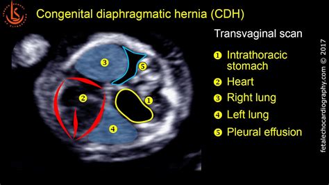 Congenital Diaphragmatic Hernia Ultrasound