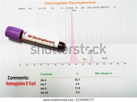 Hemoglobin Electrophoresis: Over 36 Royalty-Free Licensable Stock ...