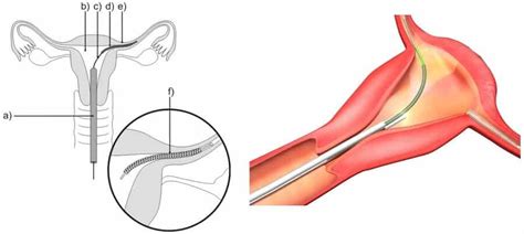 Essure Birth Control Lawsuit & Recall November 2024 - Select Justice