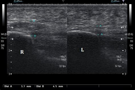 Ultrasound Images of Plantar Fasciitis - Ankle, Foot and Orthotic Centre