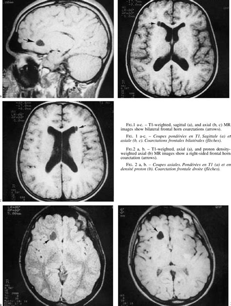 Figure 2 from MRI AND ASYMPTOMATIC COARCTATION OF THE FRONTAL LATERAL ...