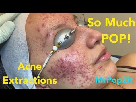 So much pop! Acne extractions on severe inflammatory acne - Mr Pop Zit ...