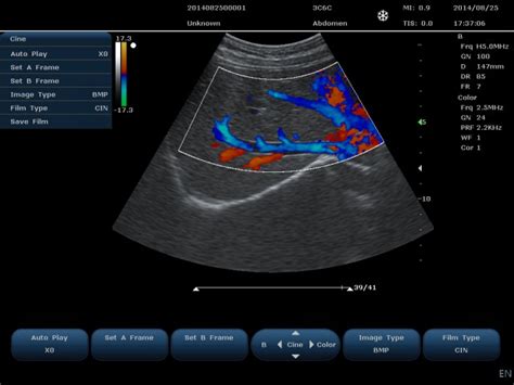 What is a Doppler ultrasound?