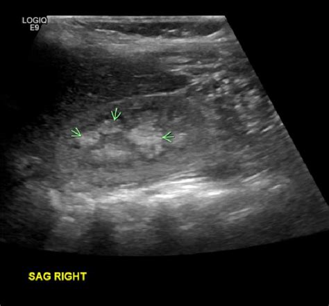 Ultrasound demonstrating medullary nephrocalcinosis. The arrows denote ...