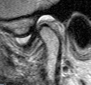 MRI TMJ JOINT – Teleradwin