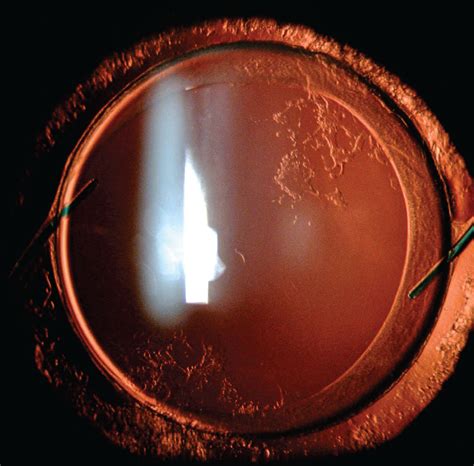 Research Identifies Main Risk Factors for Post-Cataract PCO