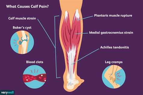 Calf Pain: Causes, Treatment, and When to See a Healthcare Provider