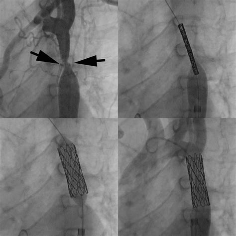 Cardiac Catheterization