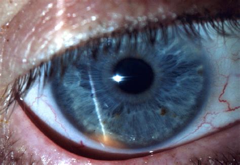 Iris-Ciliary Body Melanoma. EyeRounds.org - Ophthalmology - The ...