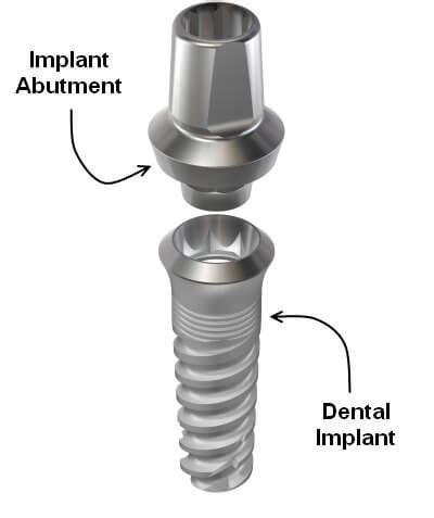 Dental Implant Abutments Explained - Glendale AZ Dentist - Dr. Lee Ann ...